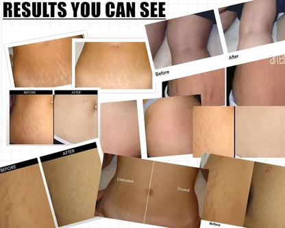 Markaway Stretch Mark Serum